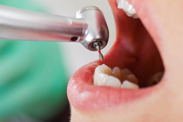 Best Knocked-Out Tooth (Avulsed Tooth) Treatment in Wautoma, WI